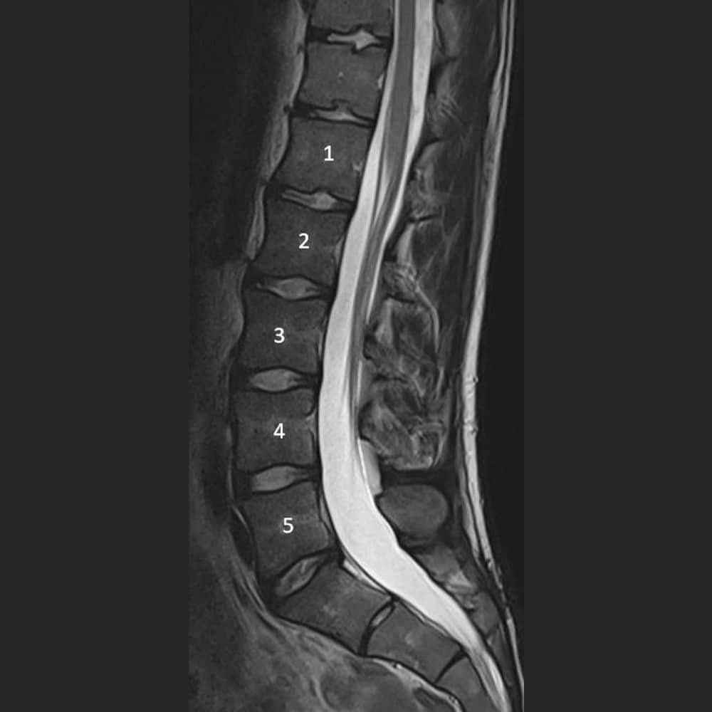 Lateral MRI image of a normal 5-limb lumbar spine