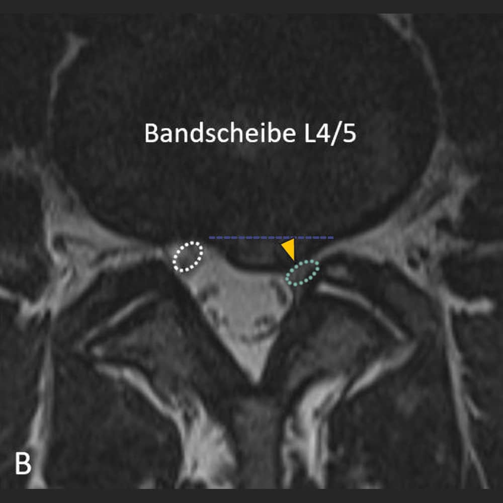 MRI spine - transversal view at the level of the L4/5 intervertebral disc