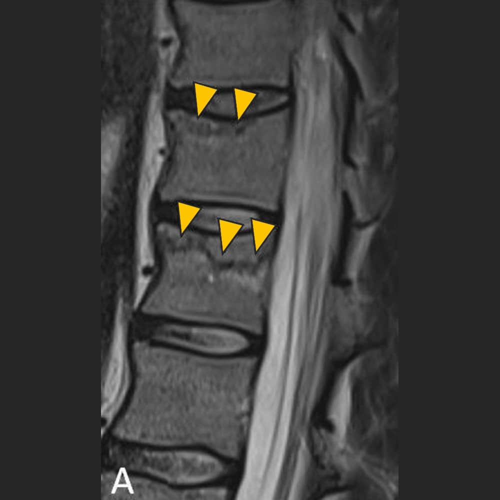Lateral MRI image of the lower thoracic spine