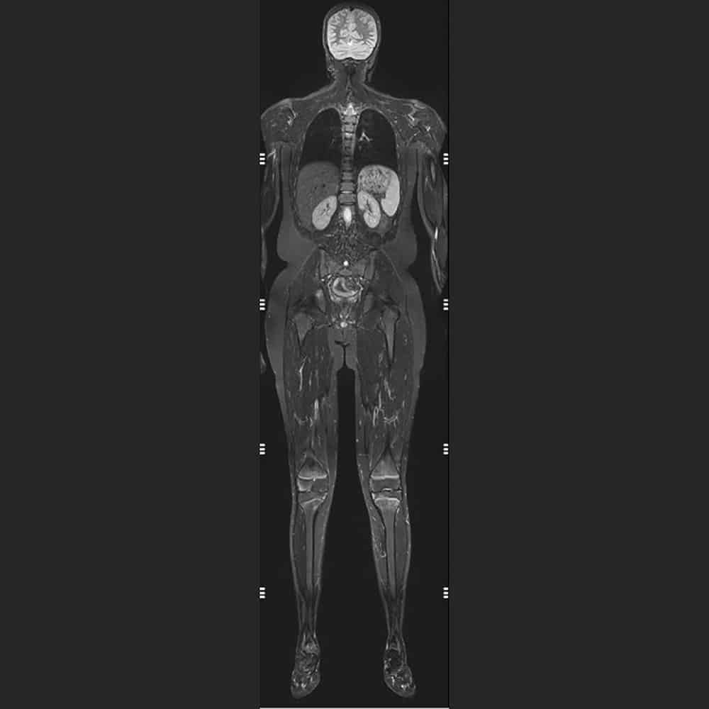 Example of a whole body scan – STIR sequence