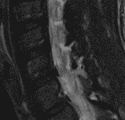 Nerve root MRI conventional 2D series