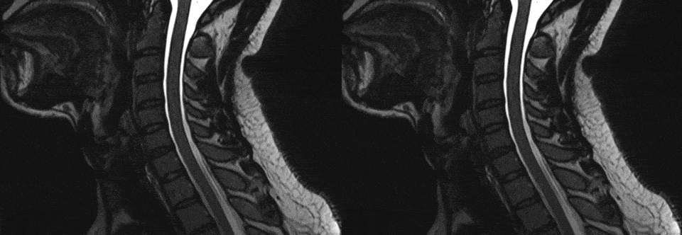 Nerve root MRI 3D sequences