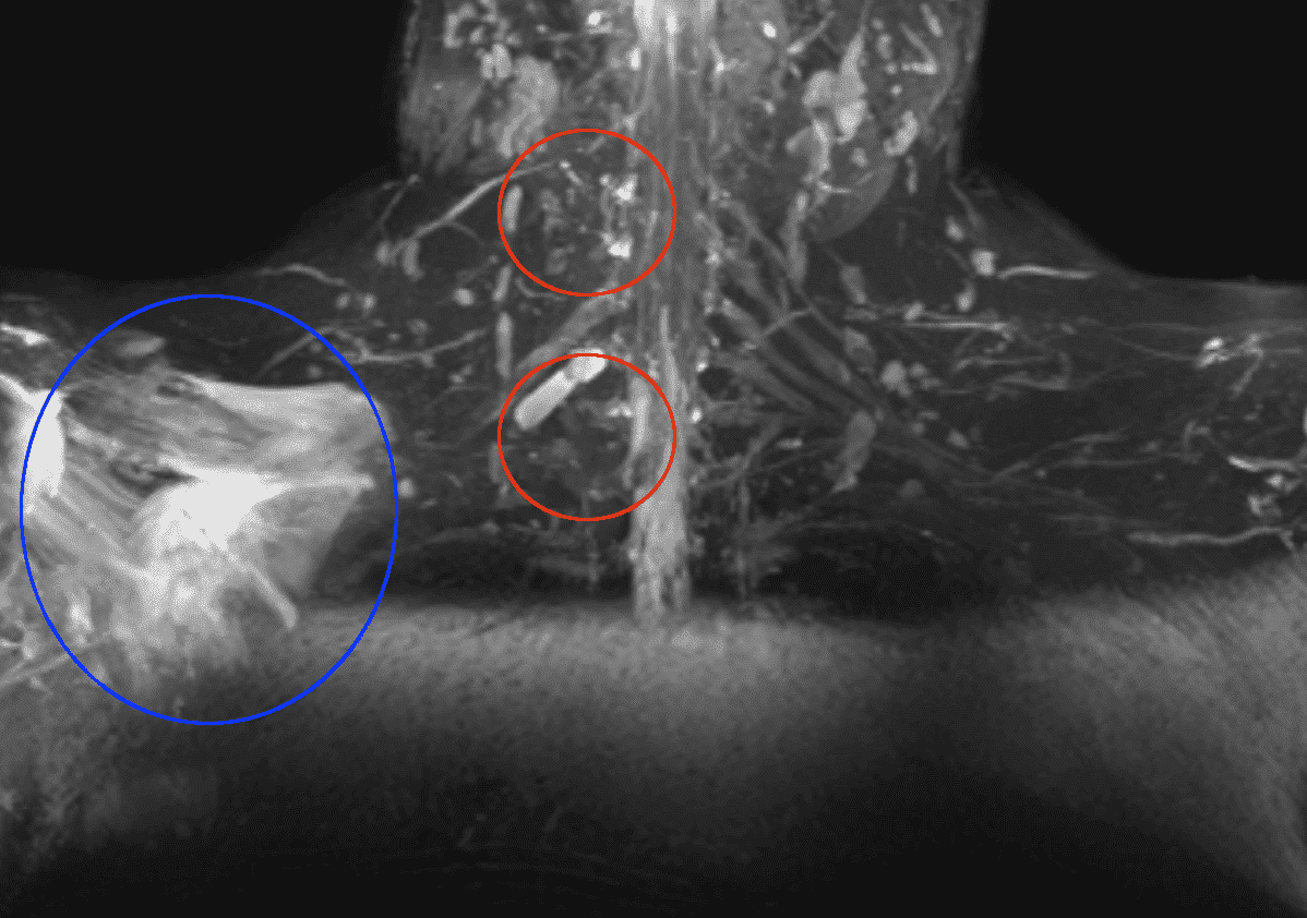 Shoulder MRI with Nerve root damage